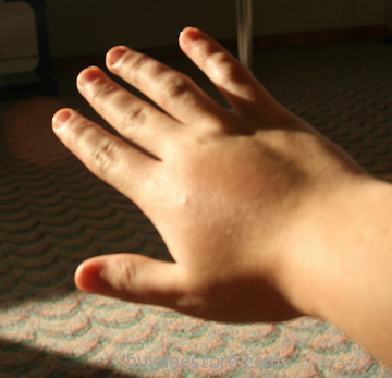 allergic symptoms blogimage